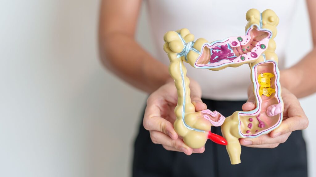 A woman holding a medical illustration of the human colon.